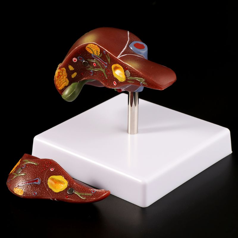 Medical Lab Technology - Human Liver Pathological Anatomical Model Anatomy
